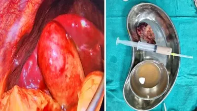 Complications of Gallbladder stone