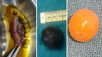 Gallstones illustration