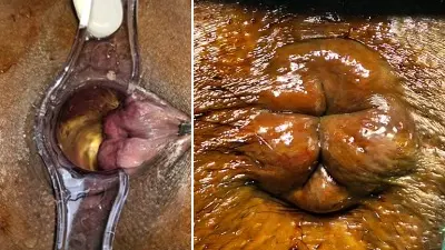 Internal and External Hemorrhoids