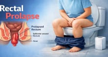 What Is Rectal Prolapse? Symptoms You Should Not Ignore