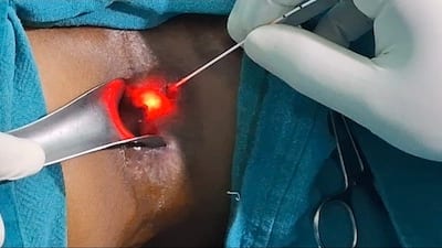 Laser treatment for hemorrhoids procedure
