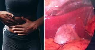 Understanding gallstone symptoms and causes