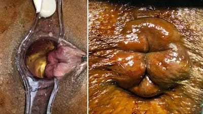 Internal and External Hemorrhoids