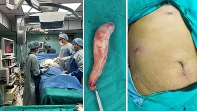 Minimally invasive laparoscopic gallbladder removal