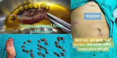 Gallbladder and pancreatic surgery for stones, cysts, and tumors