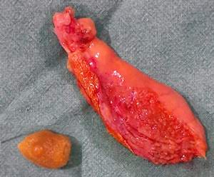 Gallbladder Stone Symptoms, Causes and Treatment