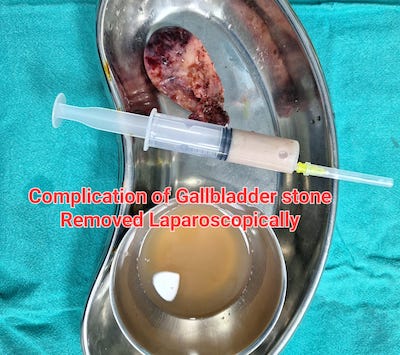 Gallbladder Stone Treatment Video by Dr. Surendra Shah