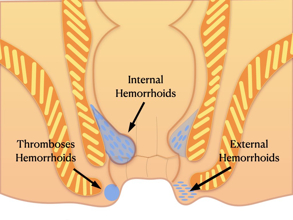 diet in hemorrhoids