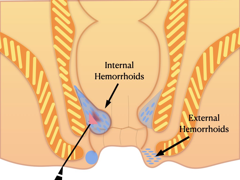 diet in hemorrhoids