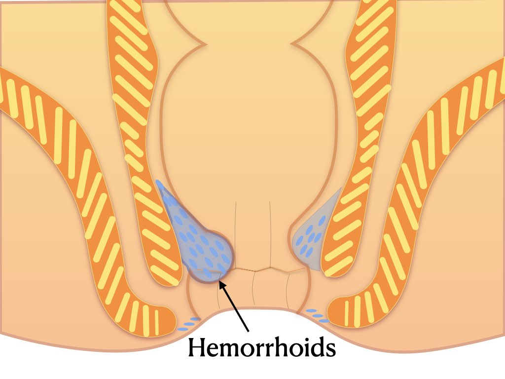 diet in hemorrhoids