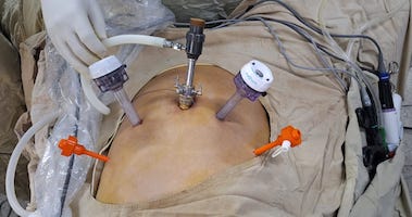 Laparoscopic Hernia Surgery Myths and Facts