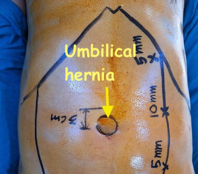 Hernia Symptoms, Signs and When to See Doctor