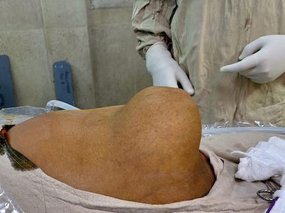 Hernia