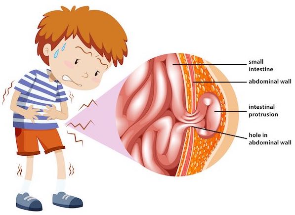 Strangulated Hernia