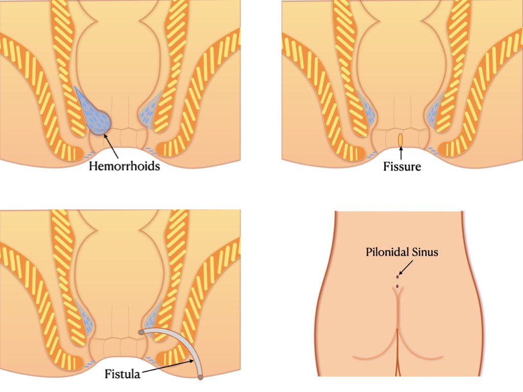 diet in hemorrhoids