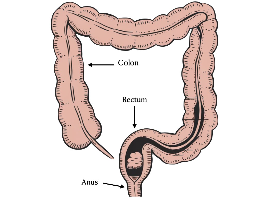 diet in hemorrhoids